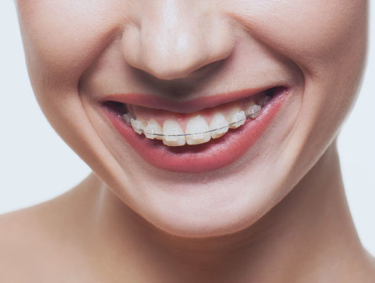 Erwachsene lächelnde Frau mit fester Zahnspange