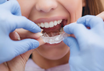 Frau in Behandlung mit durchsichtigen Invisalign® Zahnschienen