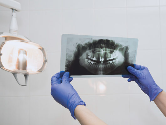 Röntgenbild des Kiefers mit Knochenaufbauten beim Zahnarzt Heidelberg